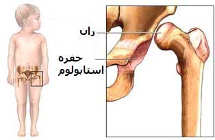 دررفتگي مادرزادي مفصل ران