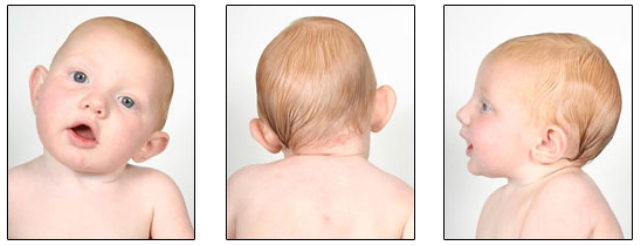 علائم کجی گردن بچه یا تورتیکولی