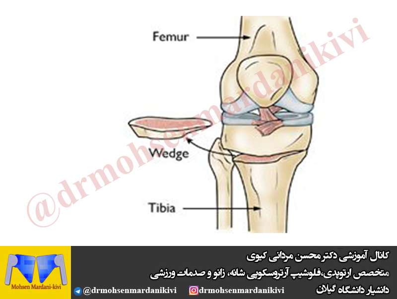 ‍ ✅استئوتومی تیبیا