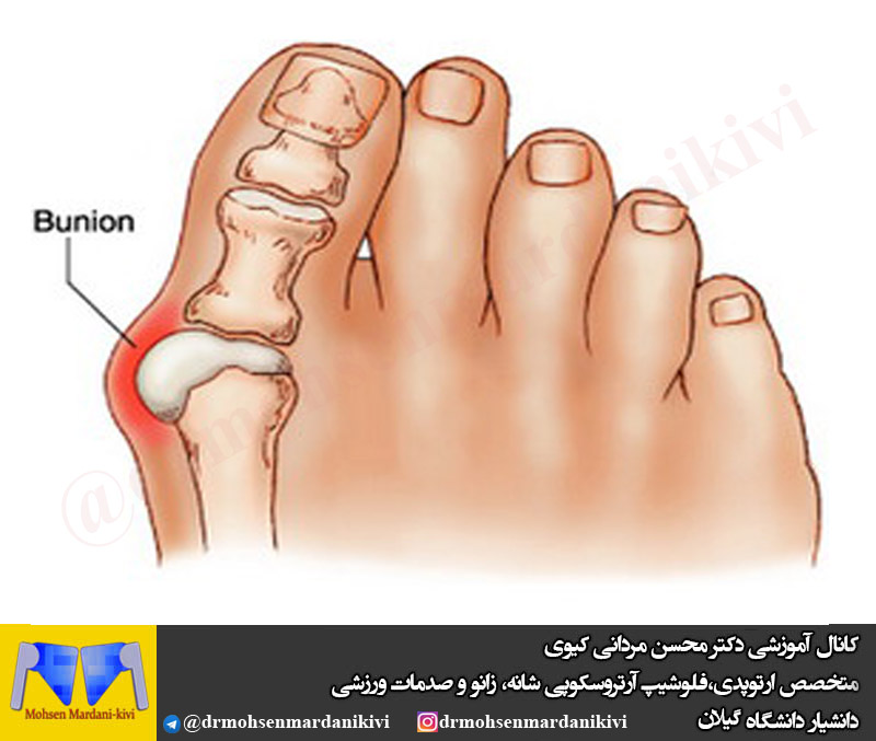 انحراف شست - هالوکس والگوس 