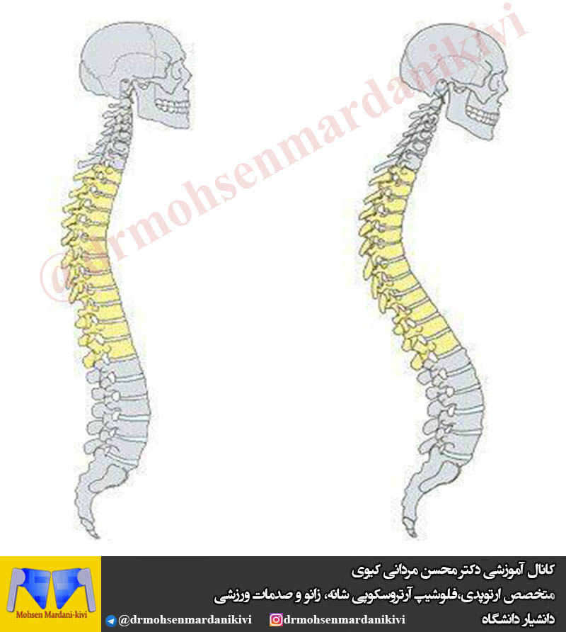 ناهنجاری کایفوز ( قوز ) چیست؟