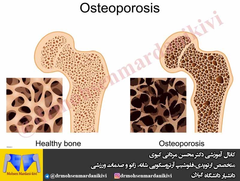پوکی استخوان