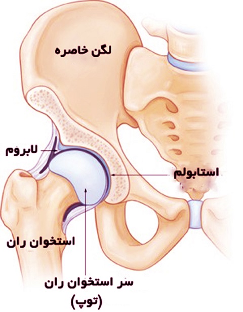 دررفتگی مفصل لگن