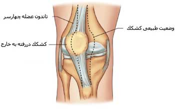 دررفتگی استخوان کشکک زانو