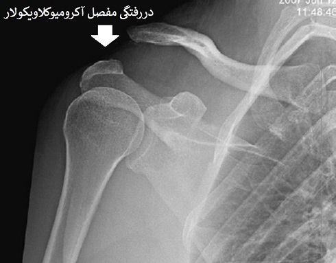 دررفتگی مفصل آکرومیوکلاویکولار