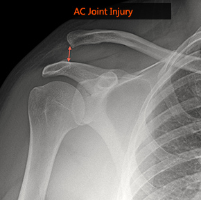  دررفتگی مفصل آکرومیوکلاویکولار