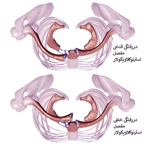 دررفتگی مفصل استرنوکلاویکولار