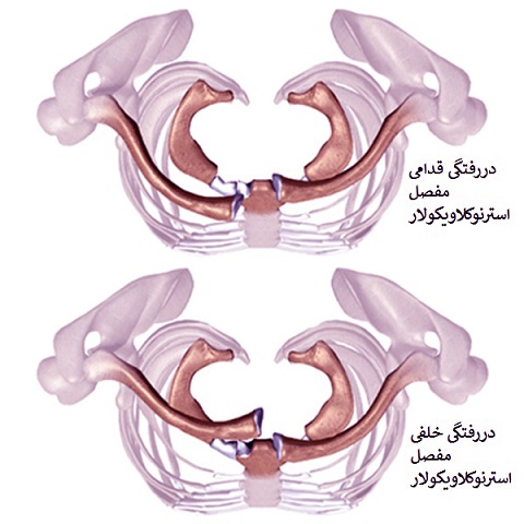  دررفتگی مفصل استرنوکلاویکولار