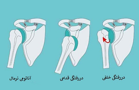 دررفتگی مفصل شانه (گلنوهومرال)