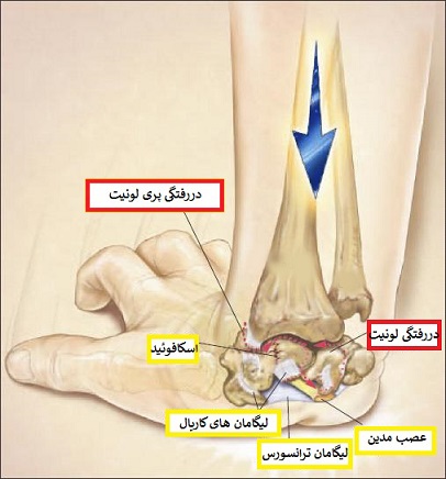 تعریف و علت دررفتگی استخوان لونیت