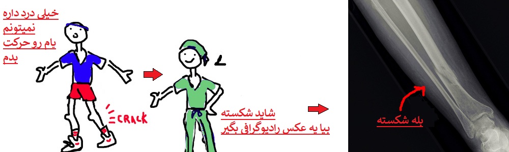 شکستگی درشت نی در بخش تنه