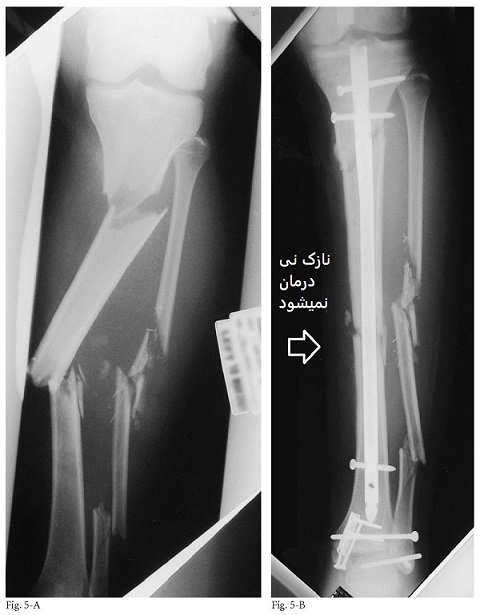  شکستگی نازک نی در بخش تنه