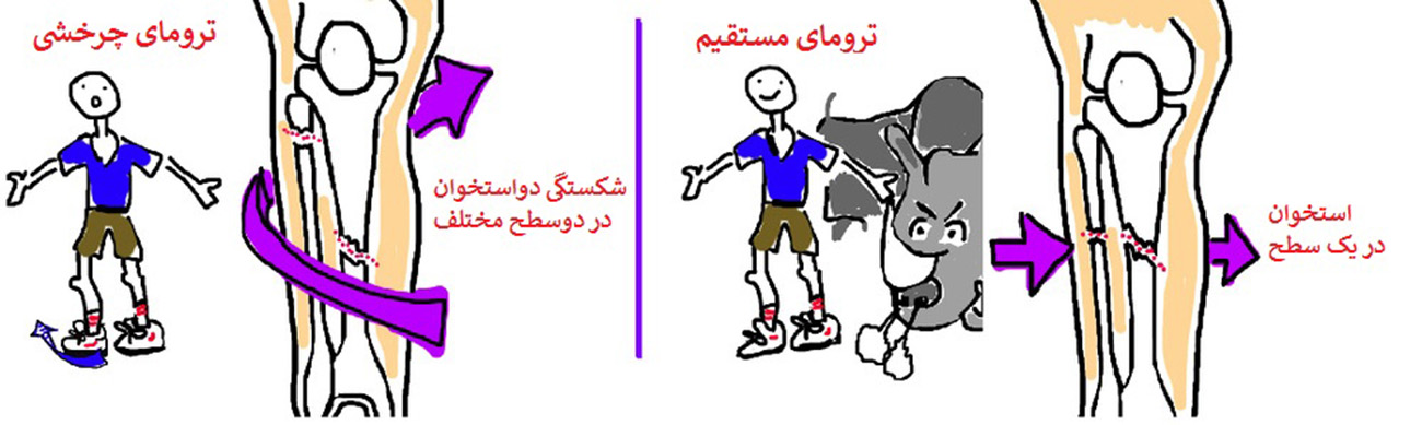 شکستگی استخوان درشت نی و نازک نی