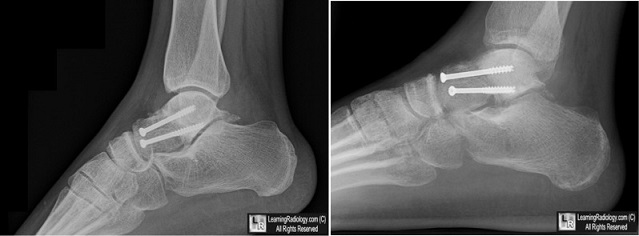 درمان شکستگی تالوس در مچ پا
