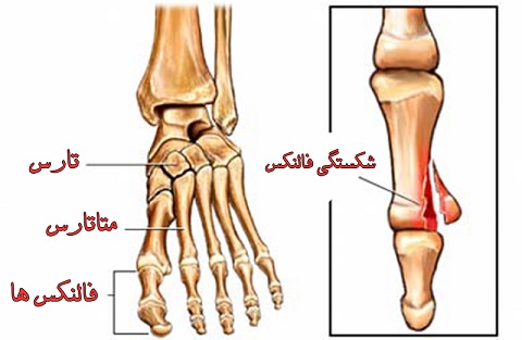 شکستگی انگشتان پا