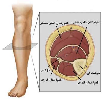 سندرم کمپارتمان