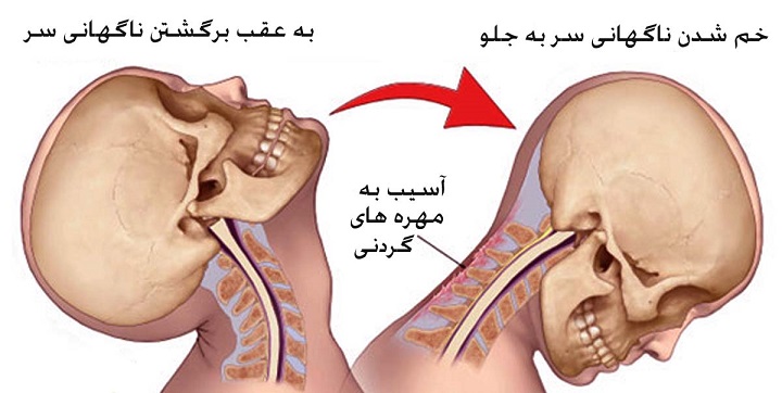 شکستگی فقرات گردنی