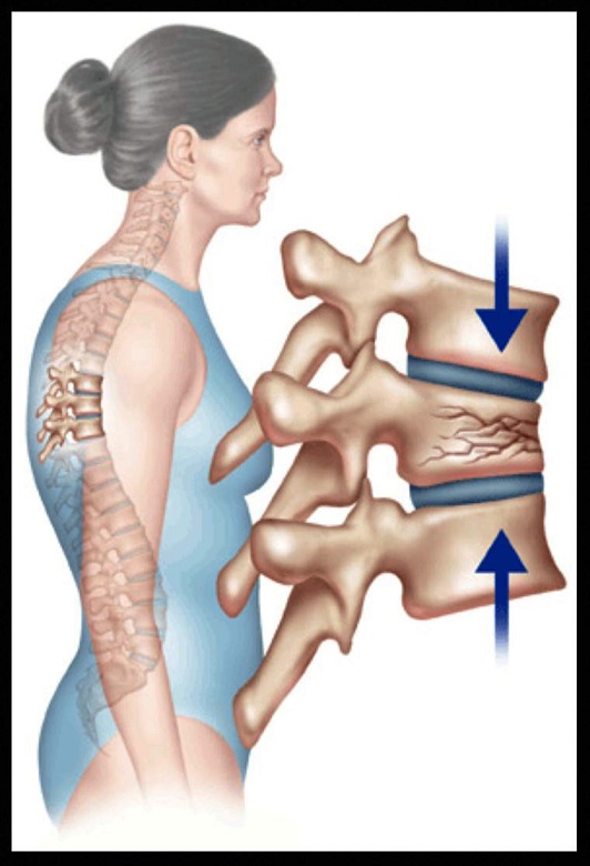 شکستگی فقرات سینه ای و کمری