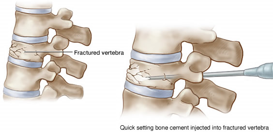 درمان شکستگی فقرات سینه ای و کمری