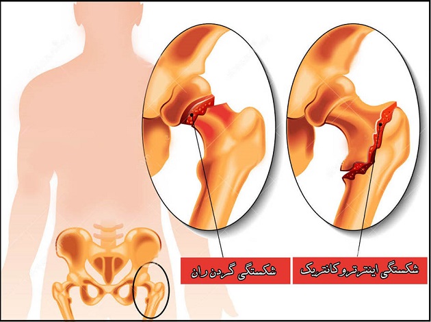 شکستگی اطراف مفصل ران