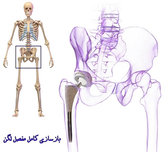 درمان شکستگی های اطراف مفصل ران