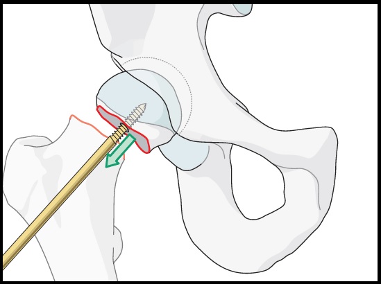 درمان شکستگی های اطراف مفصل ران