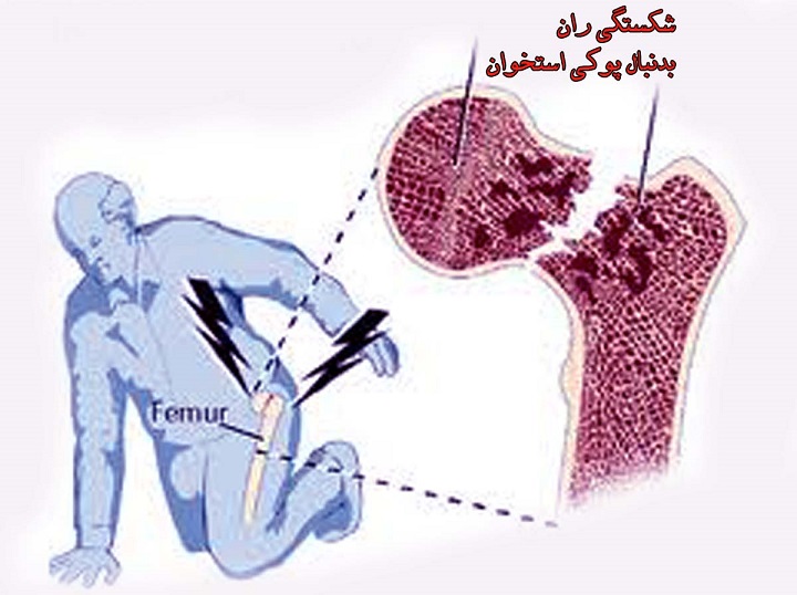 فاکتورهای خطر شکستگی لگن