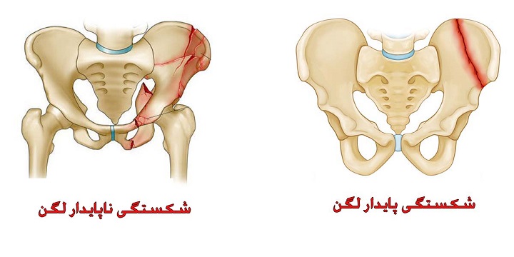 علت شکستگی حلقه لگن