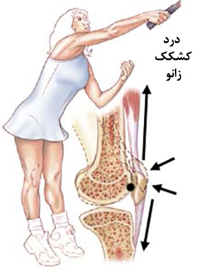 شایعترین علل دردهای مزمن زانو 