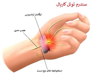 سندروم تونل کارپ