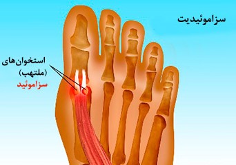 علل سزاموئیدیت