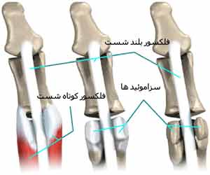 سزاموئیدیت