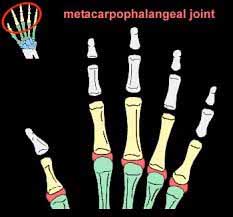 مفاصل متاکارپوفالانژیال