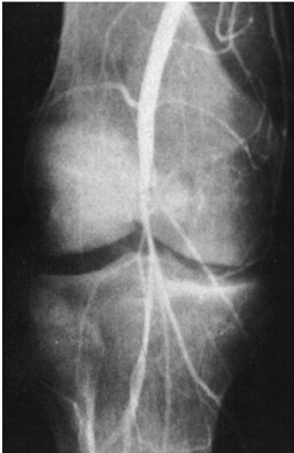 آرتريوگرام در بيمار مبتلا به دررفتگي زانو