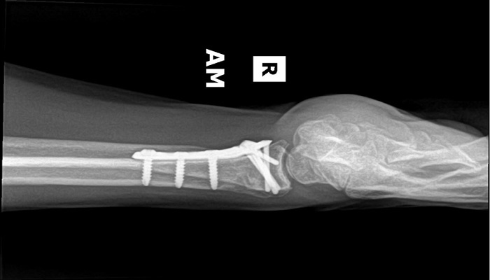 درمان های شکستگی انتهای پایینی استخوان رادیوس 