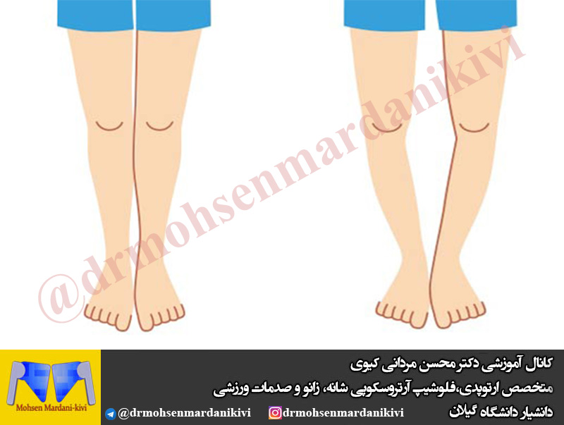 🔴زانوی پرانتزی چیست؟؟؟؟