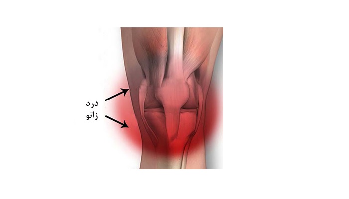 درد های زانو را چگونه تشخیص دهیم