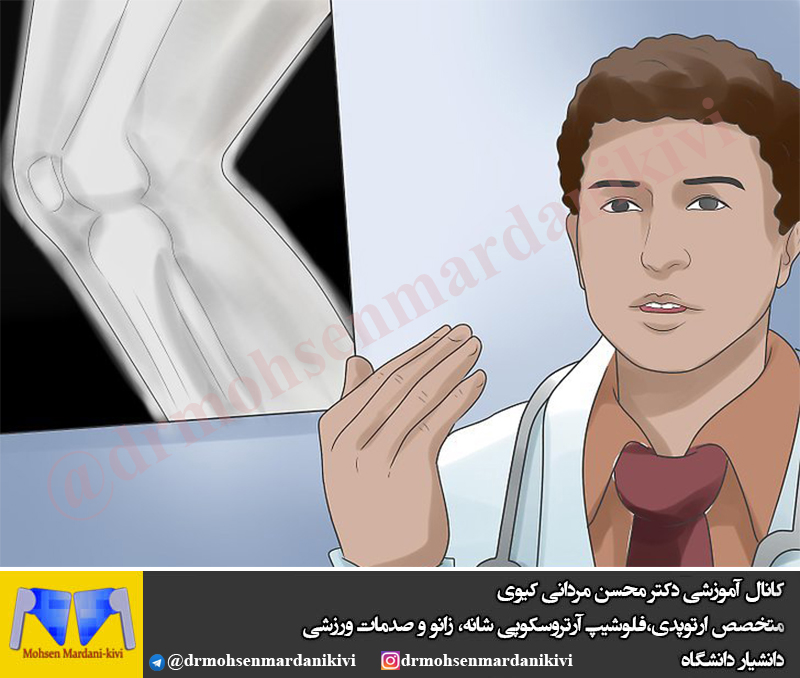 نحوه بهبودی پس از جراحی آرتروسکوپی زانو 