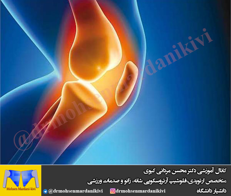 ورزش برای آرتروز زانو 